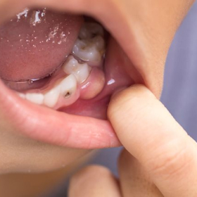 Титановый штифт в зубе