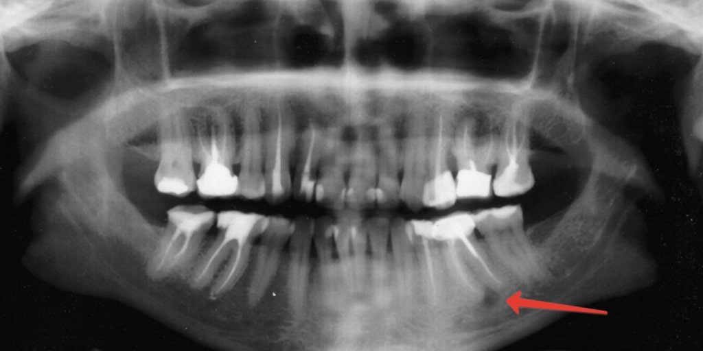 рентгеновский снимок пациента с кистой зуба
