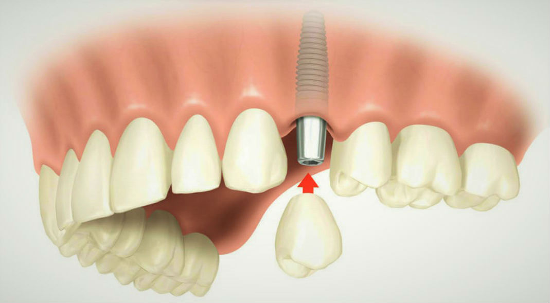 Как Выглядят Импланты Зубов Фото