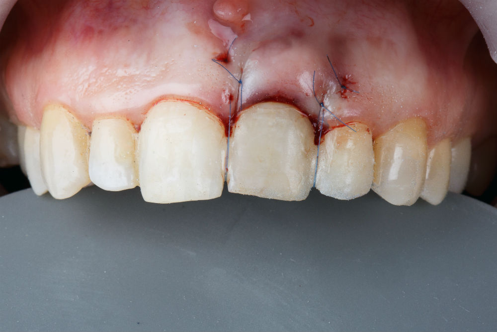 Экспресс имплантация зуба