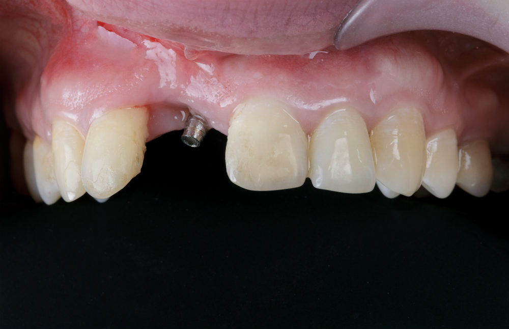 Одномоментная имплантация переднего зуба в зоне улыбки