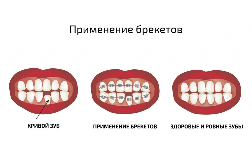 Иллюстрация процесса исправления прикуса Исправление зубов с помощью брекетов