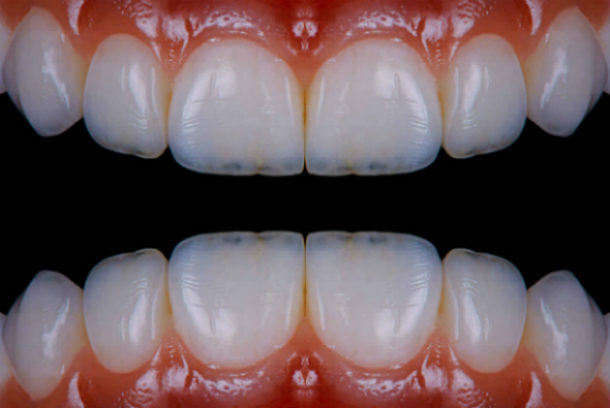 Виниры на зубы фото