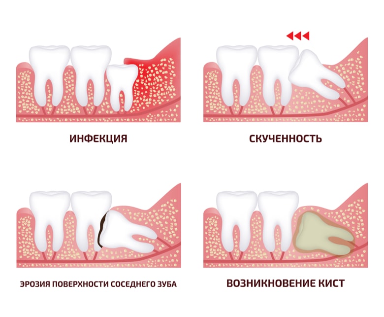 Избавляемся от зуба мудрости без боли и последствий