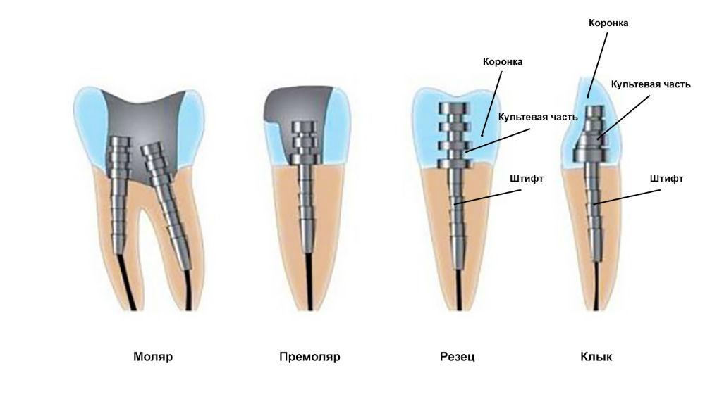Штифт в зубе металлический штифт