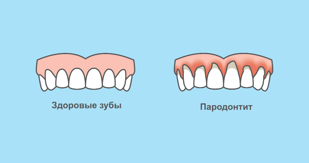 Установка брекетов в Коммунарке — на портале samaramur.ru Лечение воспаленных десен