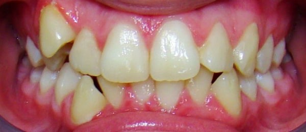 Установка брекетов для выравнивания зубов