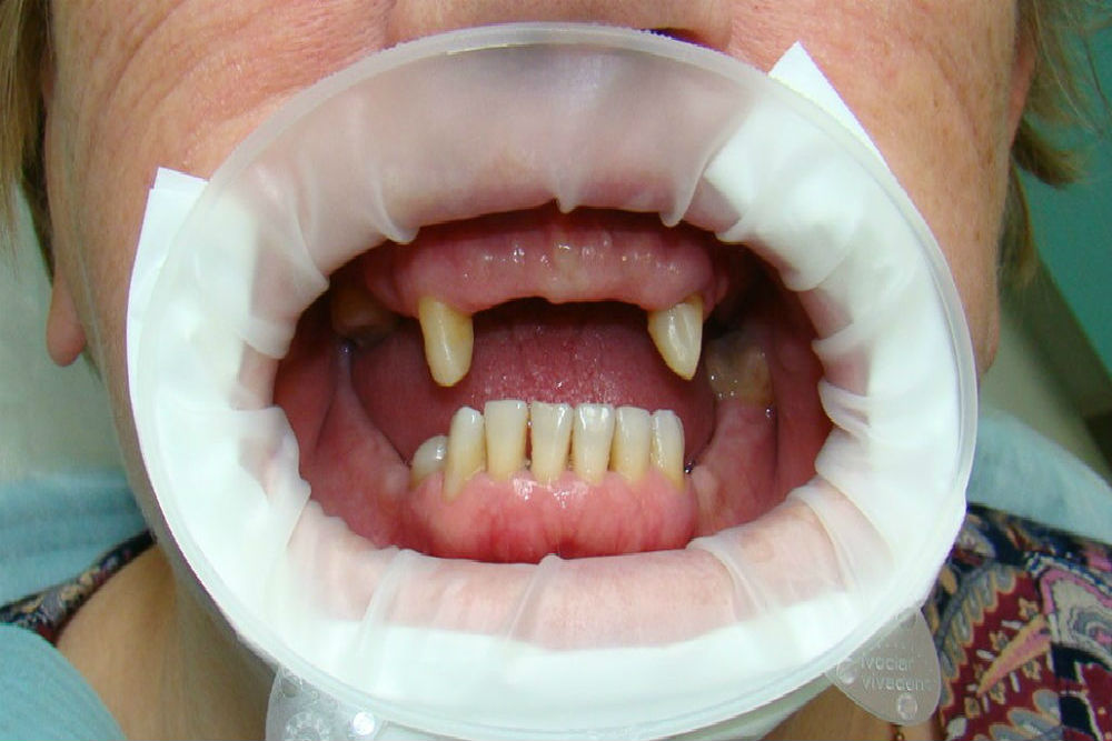 сколько по времени занимает протезирование зубов металлокерамика кредиты и микрозаймы на пробанки-инфо.ру