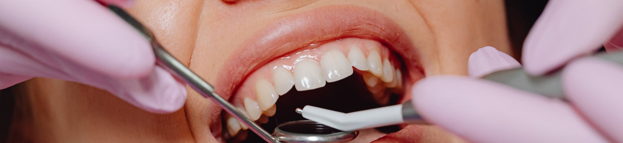 Лечение зубов: лучше вовремя, чем дорого