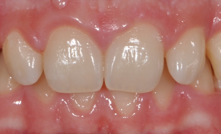 Коррекция зубного ряда брекет-системой