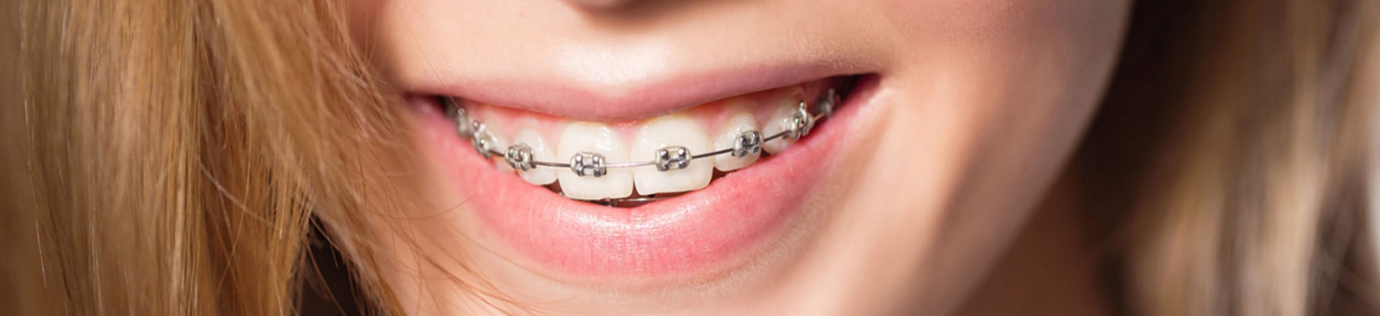Всё об установке зубных брекетов: выбор системы, этапы, сроки лечения