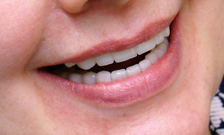 Протезирование зубов мостовидными протезами