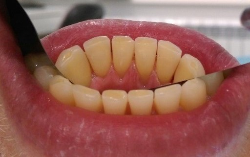 Удаление пигментированного налета на зубах и кровоточивости десен