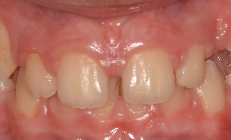 Двухэтапная коррекция выпирающих зубов аппаратом Френкеля и брекет-системой
