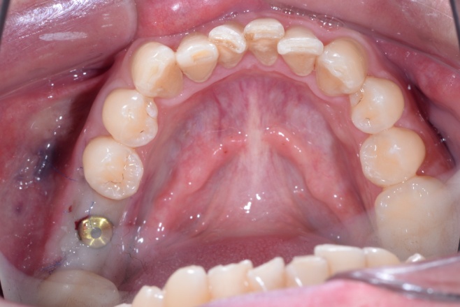 Замещение утраченного зуба имплантом Nobel Parallel