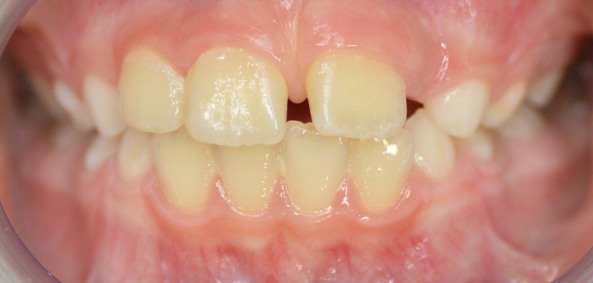 Исправление переднего зуба фото до