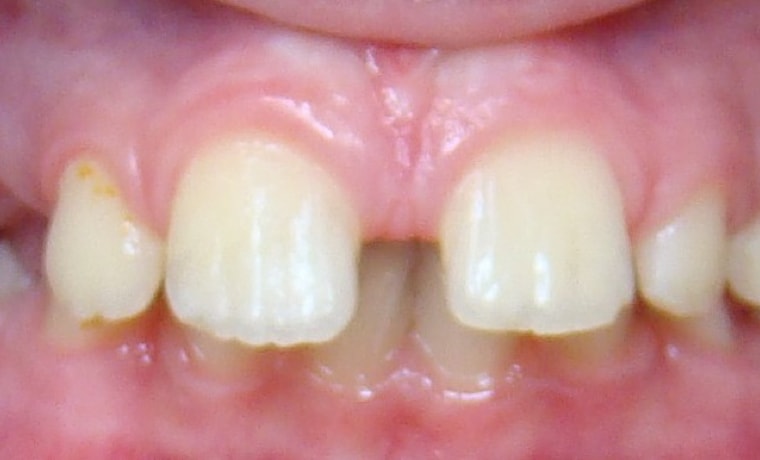 Двухэтапная коррекция выпирающих зубов аппаратом Френкеля и брекет-системой