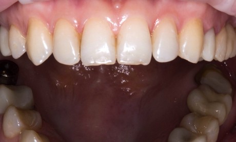 Восстановление эстетики улыбки с использованием брекетов, виниров и протезирования на имплантах и опорных зубах