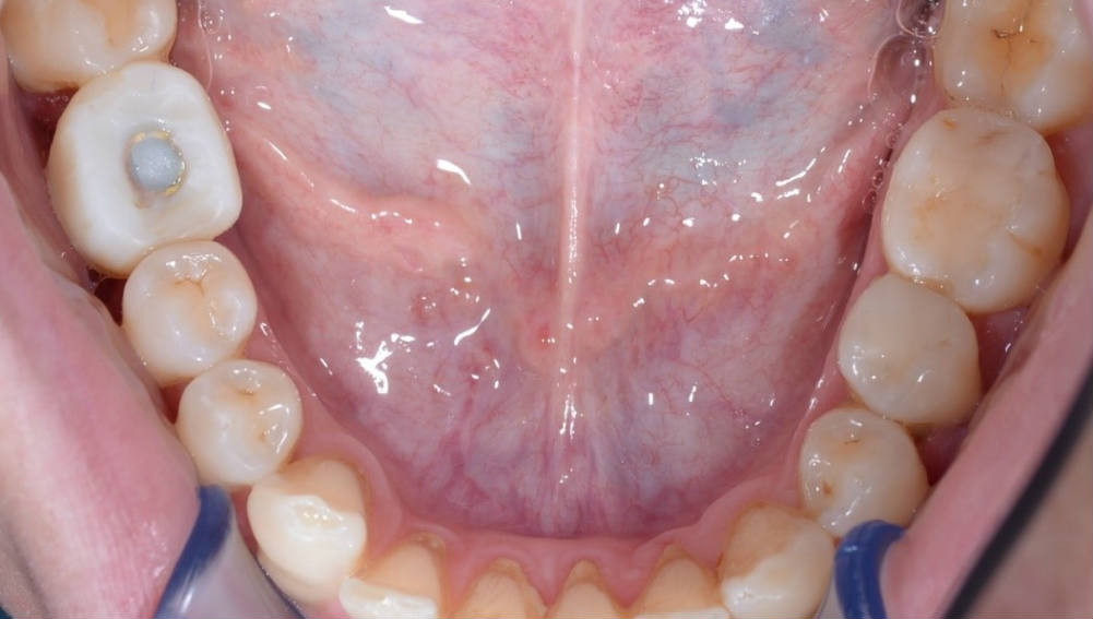 Ортодонтия перед имплантацией
