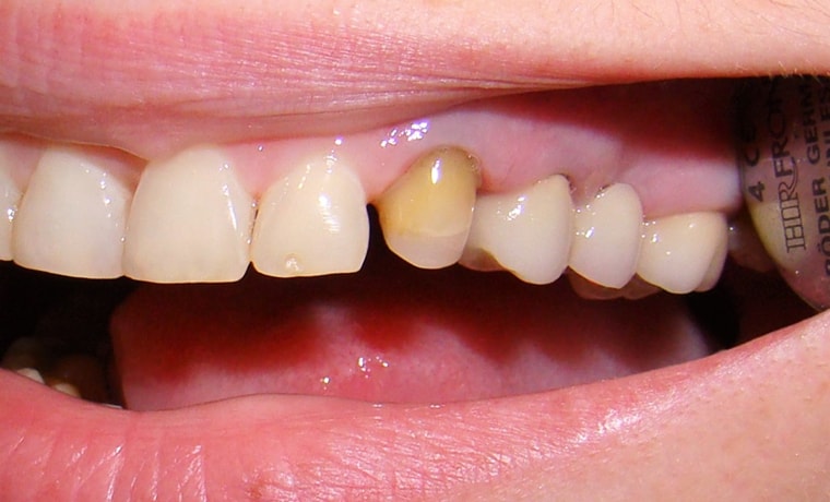 Коррекция цвета зуба с помощью цельнокерамической коронки