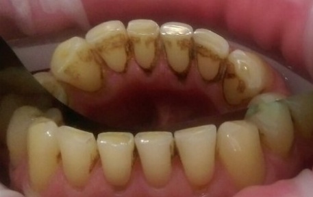 Удаление пигментированного налета на зубах и кровоточивости десен