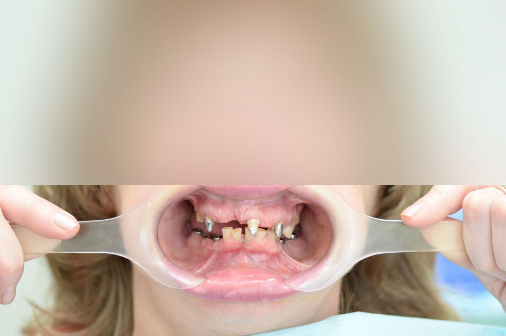 Восстановление эстетики и функциональности зубов с помощью коронок на имплантах и виниров