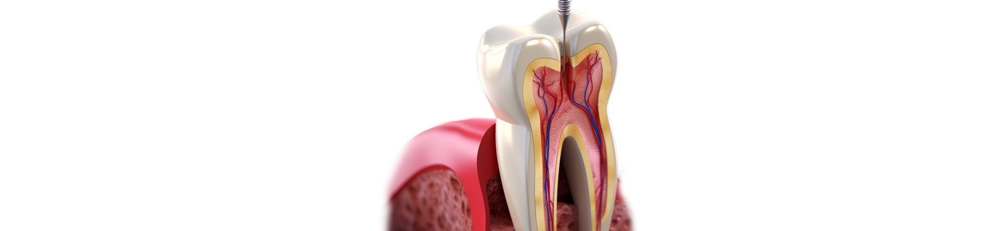 Что делать, если беспокоит зубная боль после пломбирования канала