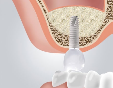 Для чего делают синус-лифтинг перед имплантацией