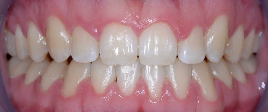 Ортодонтическое лечение брекет-системой