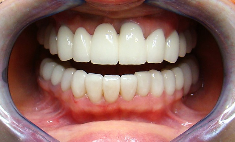 Протезирование зубов в хабаровске