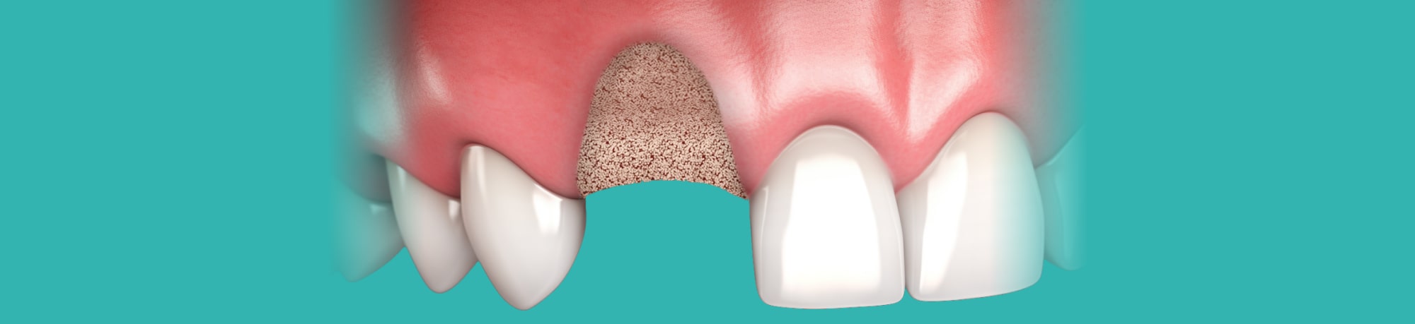 Как и для чего делают наращивание костной ткани при имплантации зубов?