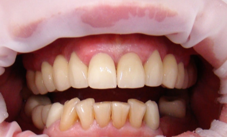 Выравнивание зубов и коррекция их цвета с помощью цельнокерамических виниров E-max press