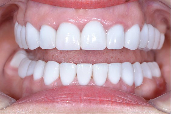 Керамические коронки на зубы: цена от 19 700 ₽ в стоматологии  EsteticaDent.ru