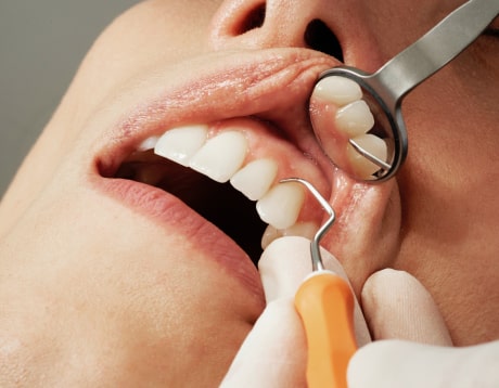 Зондирование зуба: что это такое и зачем нужно?