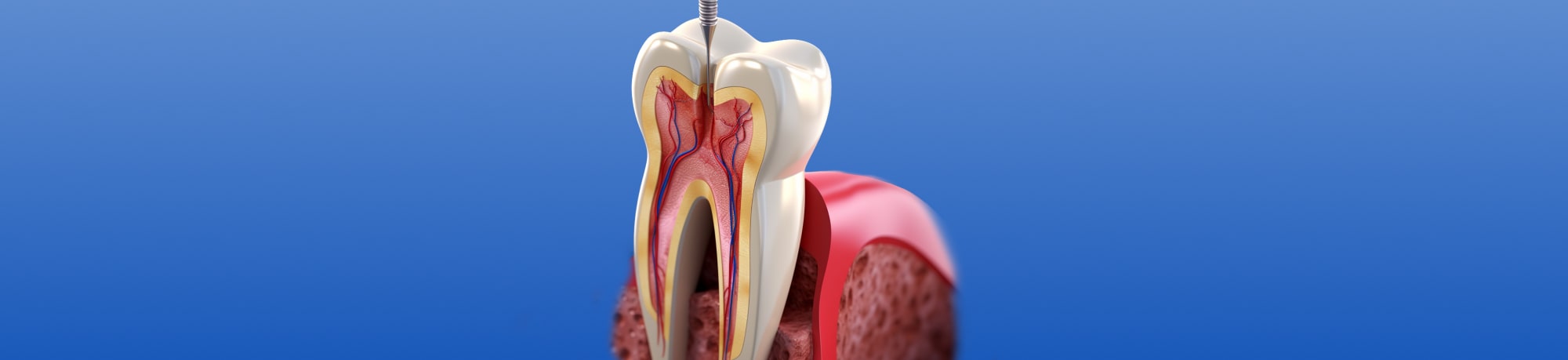 Когда и почему нужно перелечивать зубные каналы