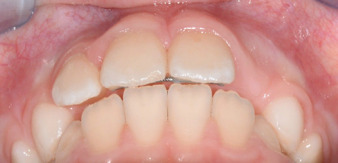 Исправление переднего зуба после
