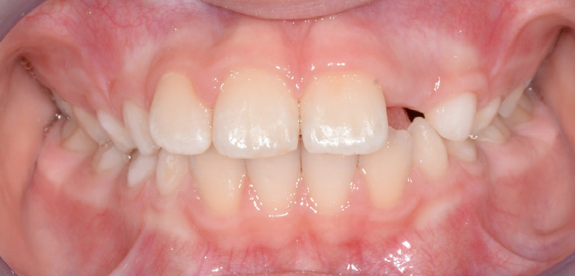 Исправление переднего зуба фото после