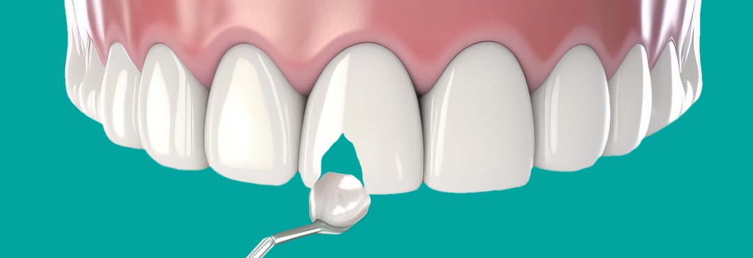 Откололся кусочек зуба – каковы причины и что делать?