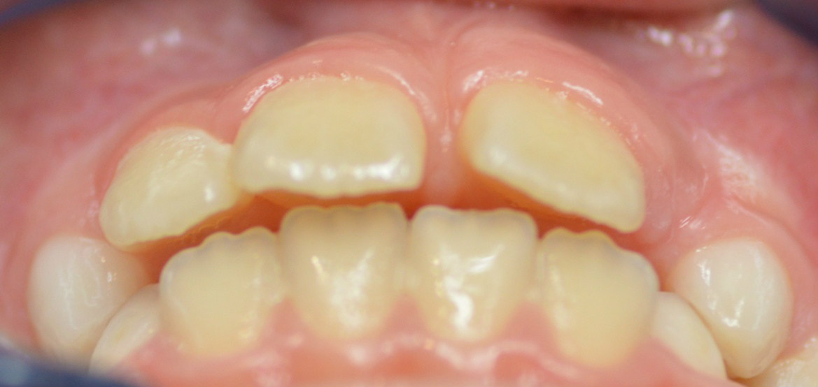 Исправление переднего зуба до