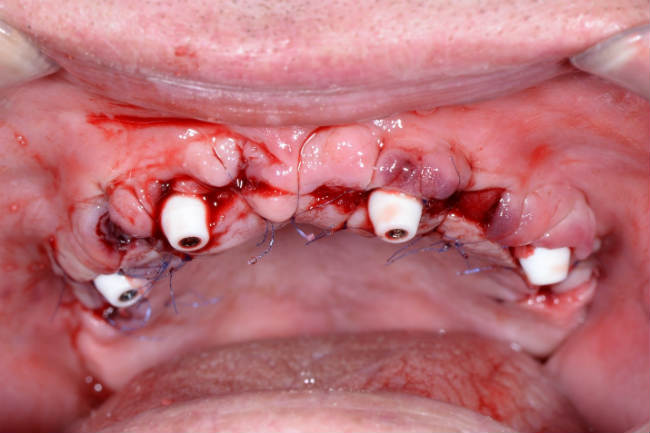 Имплантация зубов на 4 имплантах