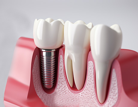 Отторжение зубного импланта