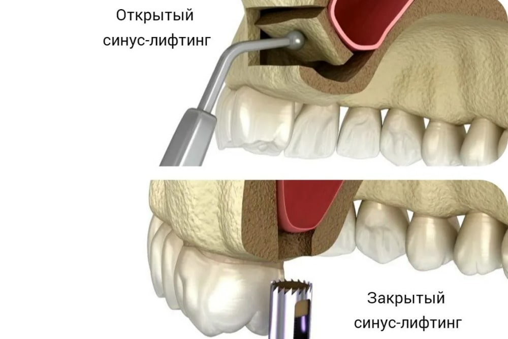 закрытый и открытый синус-лифтинг