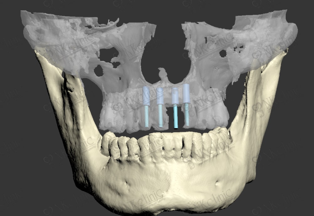 Компьютерное моделирование челюсти