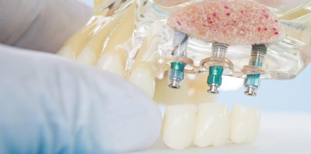 Подготовка перед имплантацией зубов