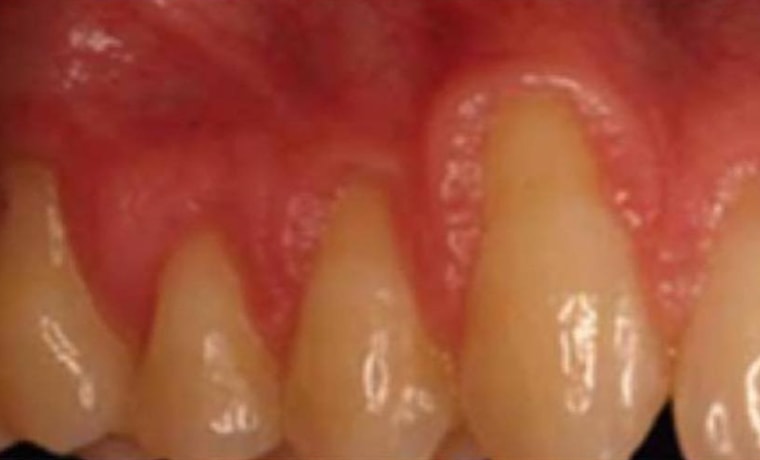 Выравнивание зубов до и после фото
