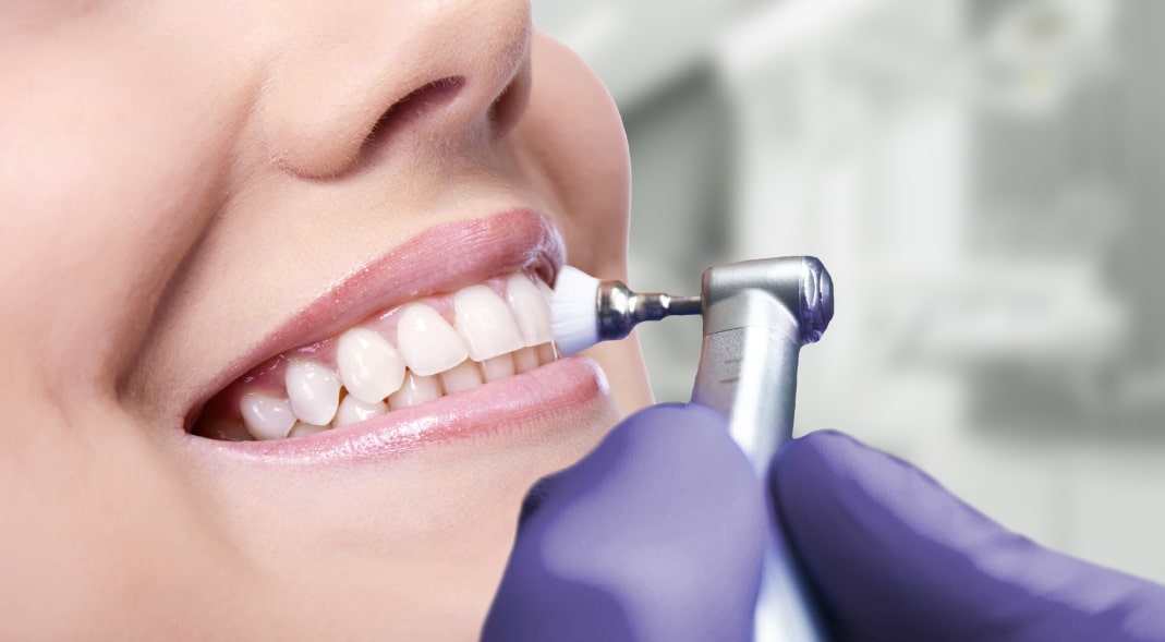 Стоматолог полирует зуб верхней челюсти