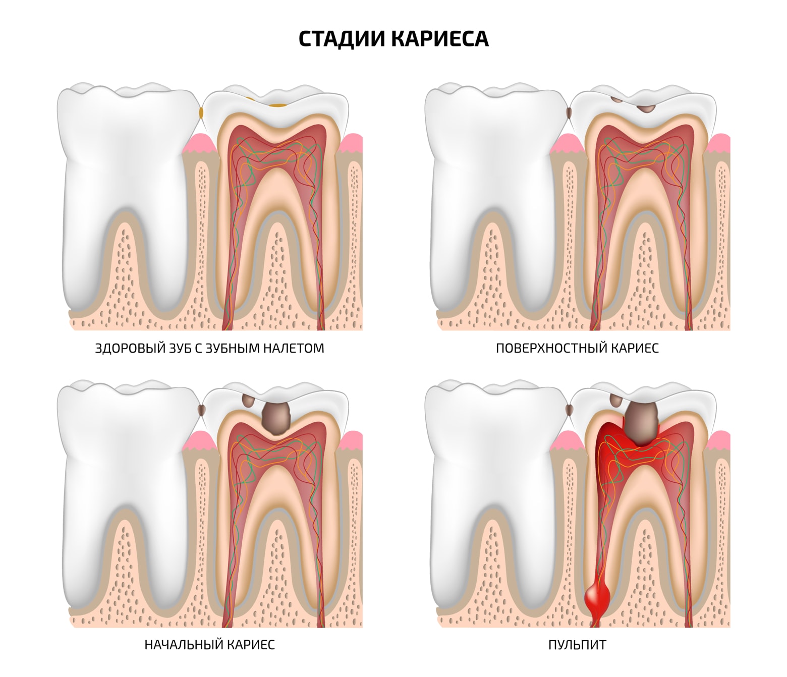 Иллюстрация четырех стадий развития кариеса