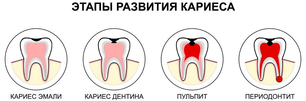 Развитие кариеса Этап развития кариеса зуба, если не делать профилактику