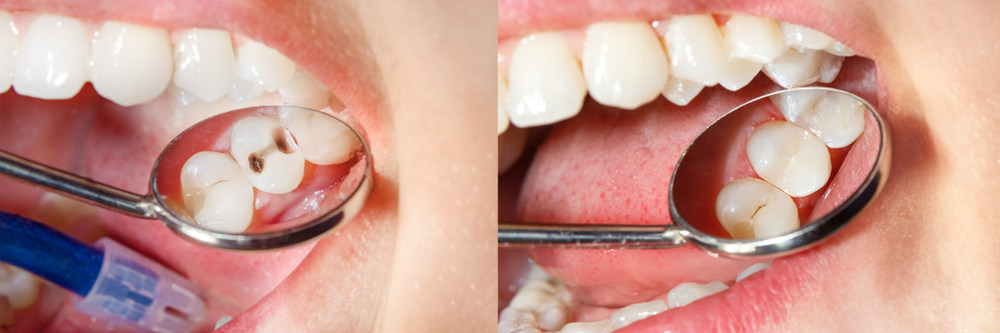 Пульпит зуба мудрости - причины, симптомы и лечение в West Dental Пульпит зуба мудрости