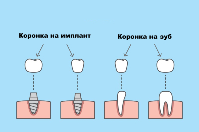 Процесс установки коронки на имплант и зуб Коронка на зуб и на имплант